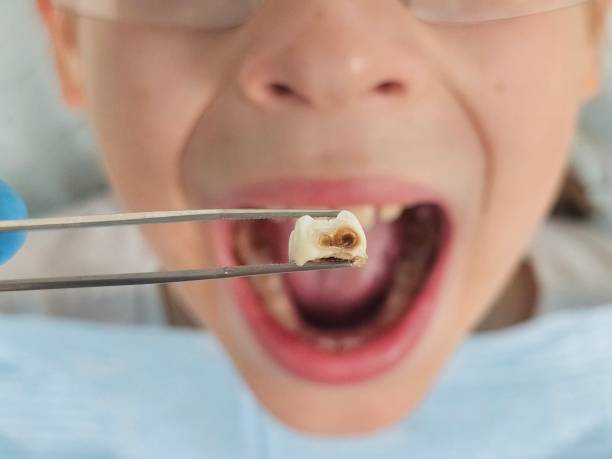 Best Tooth Pain Emergency Relief  in Los Gatos, CA